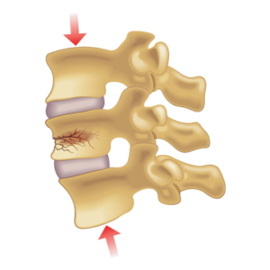 Compression Fracture