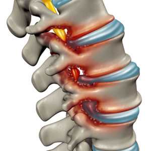 Spinal Stenosis