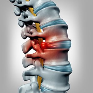 Herniated Disc Disease