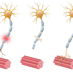 Neuropathy